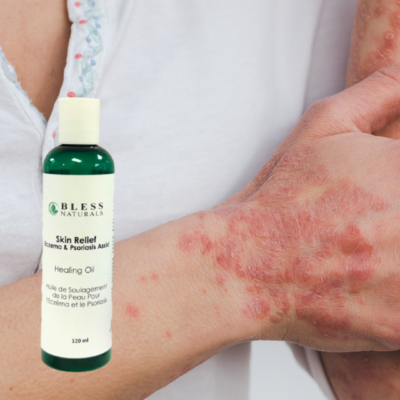Eczema & Psoriasis Relief Oil Rub 120ml